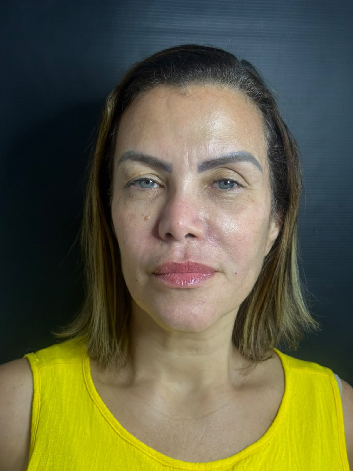 Depois do procedimento